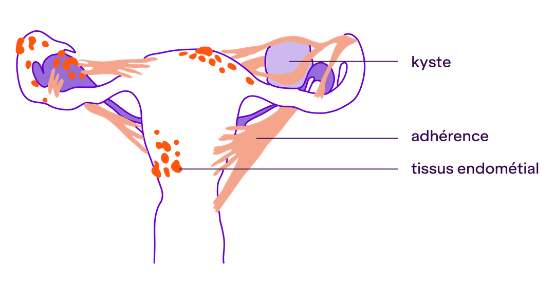 schéma : Schéma en coupe d'un utérus présentant des boules oranges qui représentent des foyers d'endométriose enflammées. On dirait qu'elles colonisent l'utérus et se propagent. On voit également de adhérences s'accrocher comme de la colle aux différentes parties de l'utérus. 