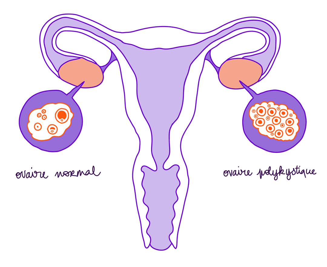 schéma : Le schéma représente un utérus en coupe. Du côté gauche, l'ovaire contient un nombre normal de follicules et kystes. Du côté droit, l'ovaire est anormalement rempli de kystes et follicules en grande quantité, comme dans le cas d'une personne souffrant de SOPK.