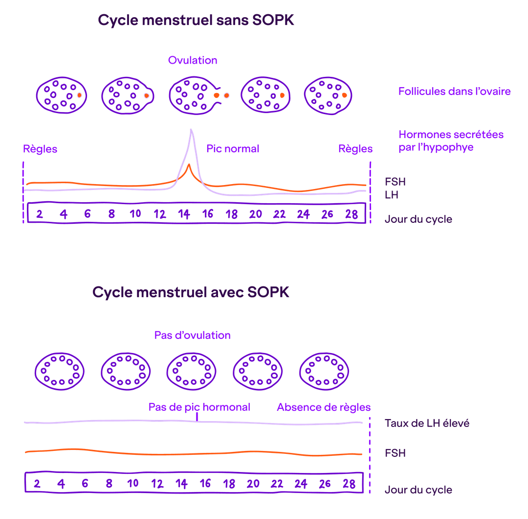 schéma : Schéma représentant le cycle menstruel avec ou sans SOPK. Lorsqu'il n'y a pas de SOPK, pendant la période d'ovulation, on observe un pic normal d'hormones sécrétées par l'hypophyse. Lorsqu'il y a un SOPK, il n'y a pas de pic hormonal pendant l'ovulation, il y a une absence de règles et un taux de LH anormalement élevé.