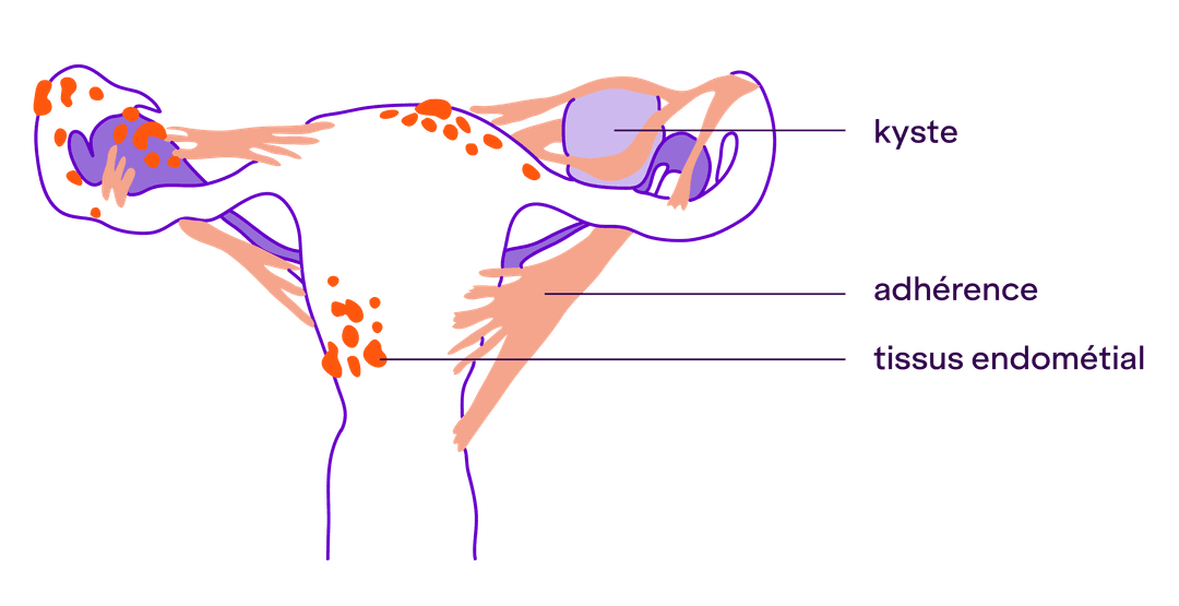 schéma : Schéma en coupe d'un utérus présentant des boules oranges qui représentent des foyers d'endométriose enflammées. On dirait qu'elles colonisent l'utérus et se propagent. On voit également de adhérences s'accrocher comme de la colle aux différentes parties de l'utérus.